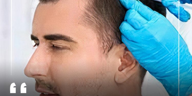 Top 10 best hair transplant in Dubai