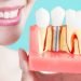 dental implants in Dubai